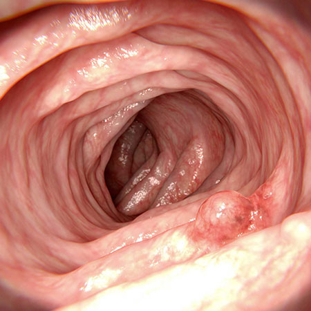 USPSTF Recommendation: Screening for Colorectal Cancer