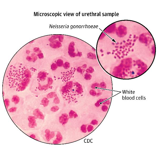 Diagnosis and Treatment of Sexually Transmitted Infections