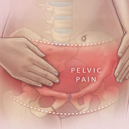 Diagnosis and Clinical Care of Women With Chronic Pelvic Pain