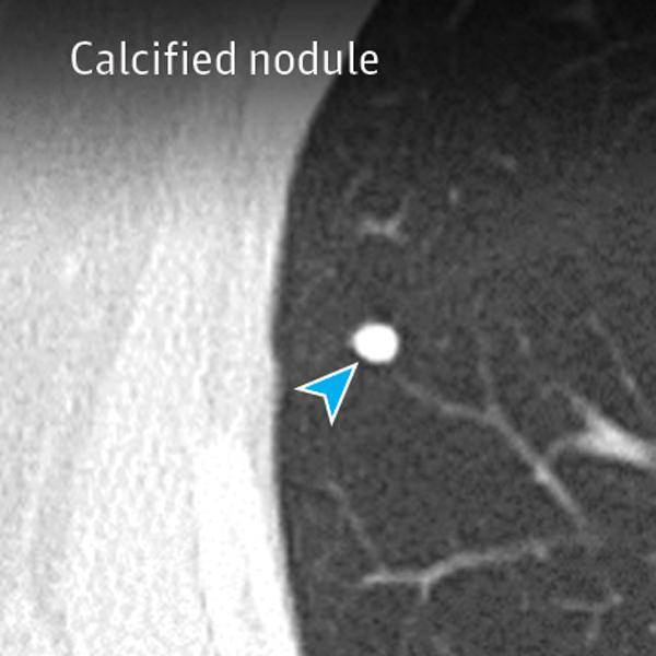 Evaluation and Management of Patients With Pulmonary Nodules