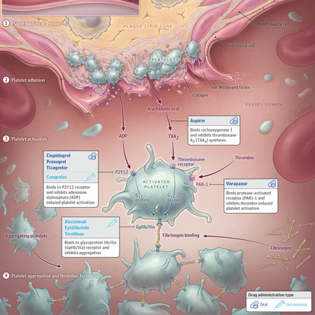 Dual Antiplatelet Therapy After Acute Coronary Syndrome