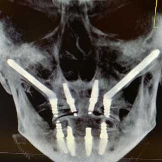 ZygoMatic