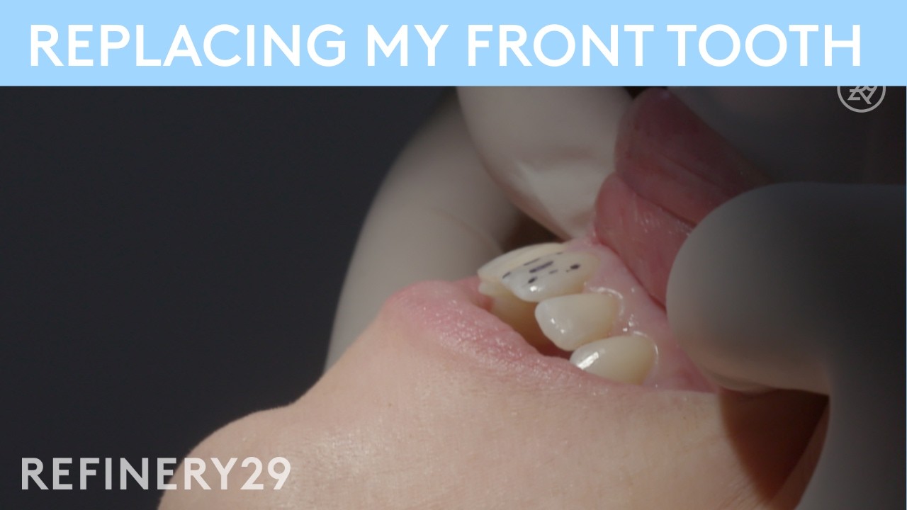 I Had to Replace My Front Tooth | Refinery29 | Macro Beauty cover art