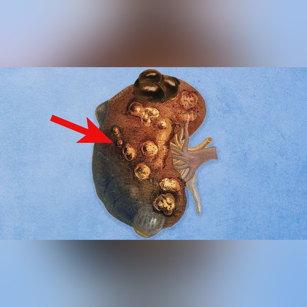What Was Growing In His Kidneys Started Growing Everywhere